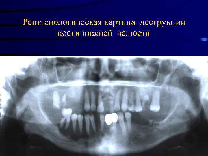 Рентгенологическая картина деструкции кости нижней челюсти 