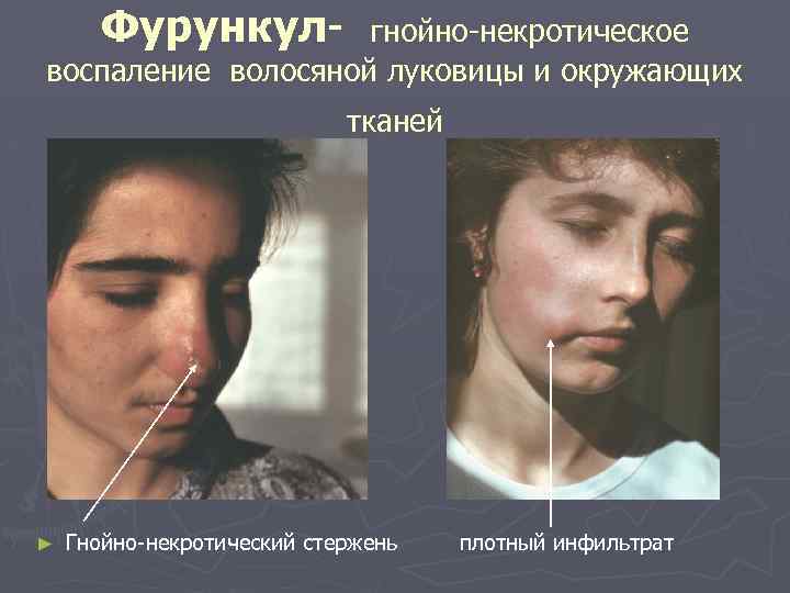 Фурункул- гнойно-некротическое воспаление волосяной луковицы и окружающих тканей ► Гнойно-некротический стержень плотный инфильтрат 