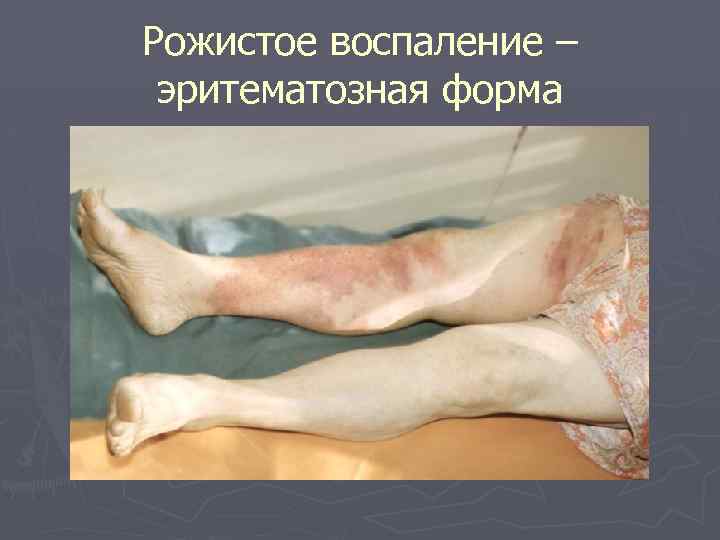 Рожистое воспаление – эритематозная форма 