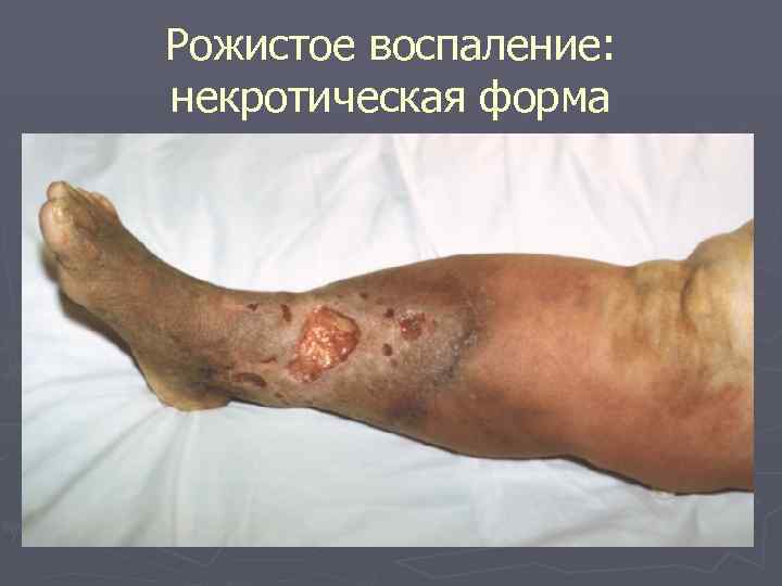 Рожистое воспаление: некротическая форма 