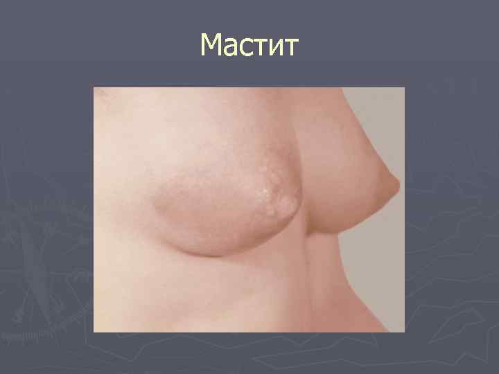 Мастит 