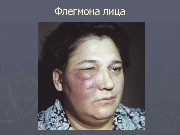 Флегмона лица 