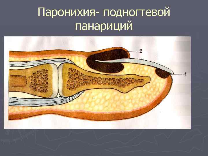 Паронихия- подногтевой панариций 