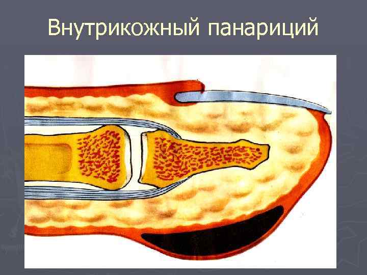 Внутрикожный панариций 