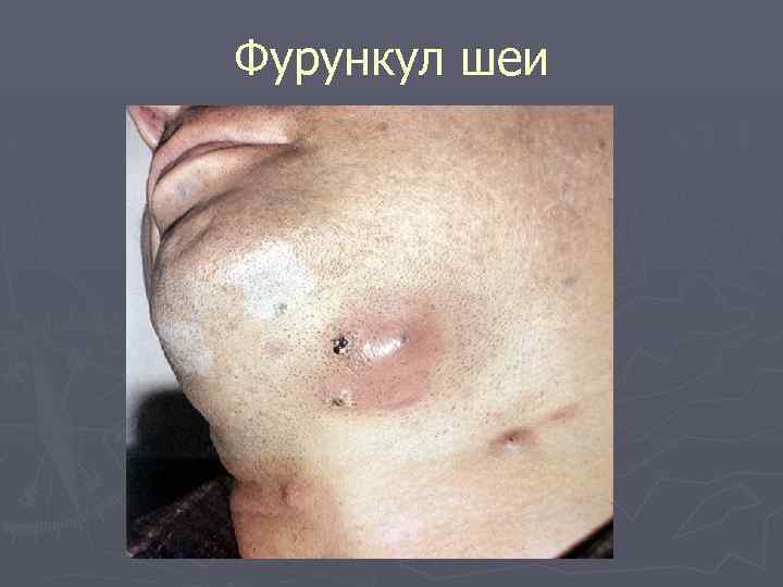 Фурункул шеи 