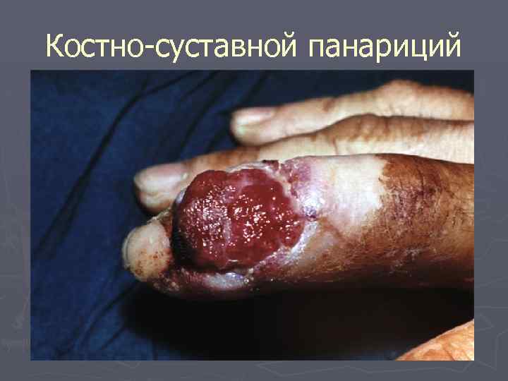 Костно-суставной панариций 