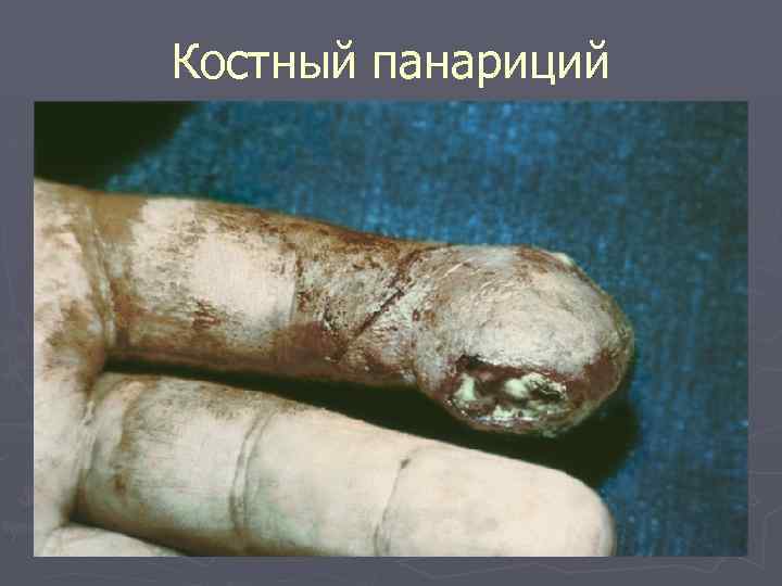 Костный панариций 