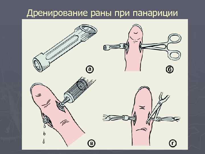 Дренирование раны при панариции 