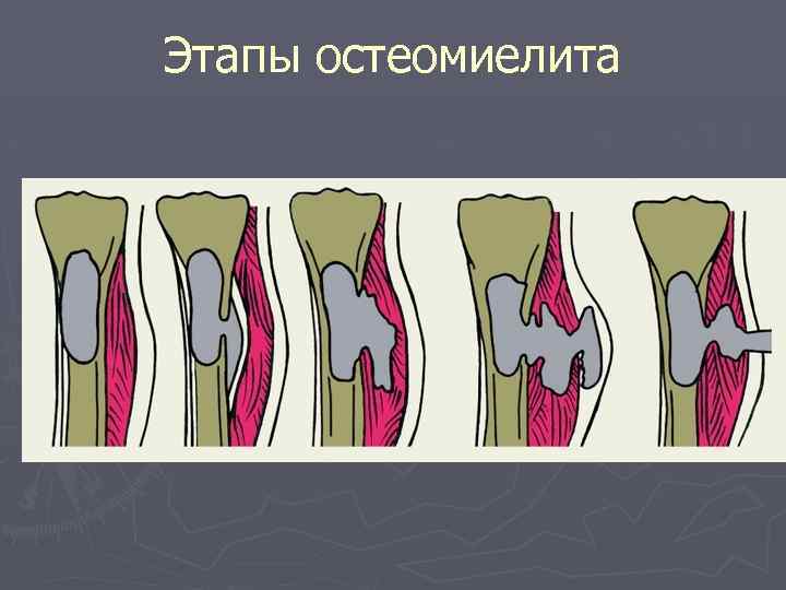 Этапы остеомиелита 