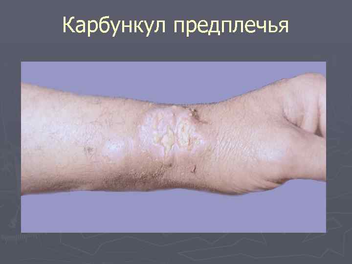 Карбункул предплечья 