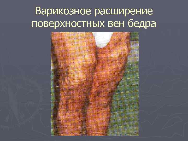 Варикозное расширение поверхностных вен бедра 