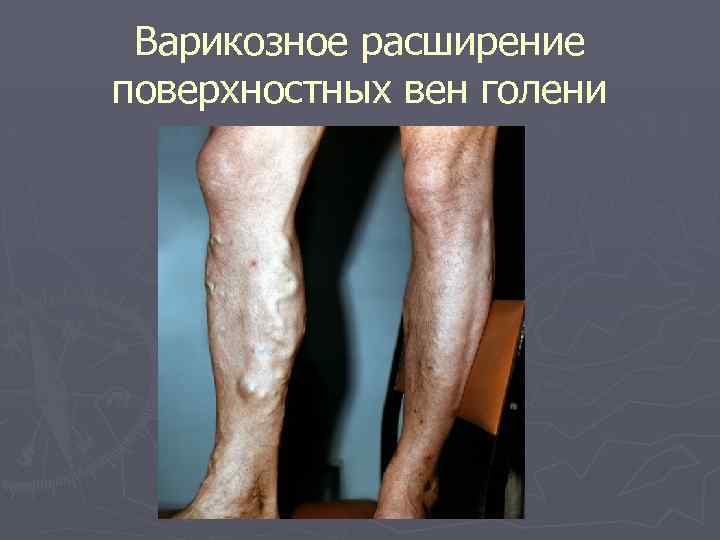 Варикозное расширение поверхностных вен голени 