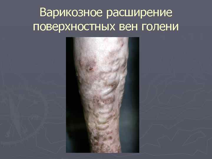 Варикозное расширение поверхностных вен голени 