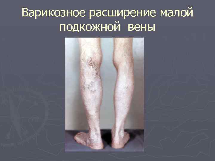 Варикозное расширение малой подкожной вены 