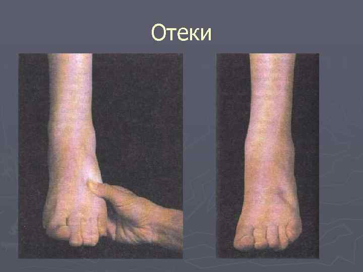 Отеки 