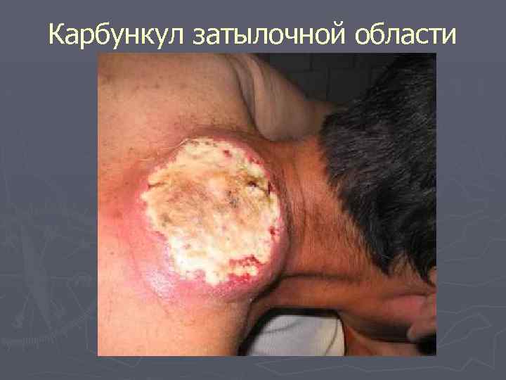 Карбункул затылочной области 