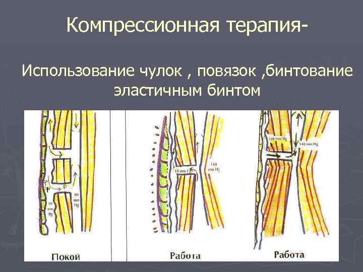 Компрессионная терапия. Использование чулок , повязок , бинтование эластичным бинтом 