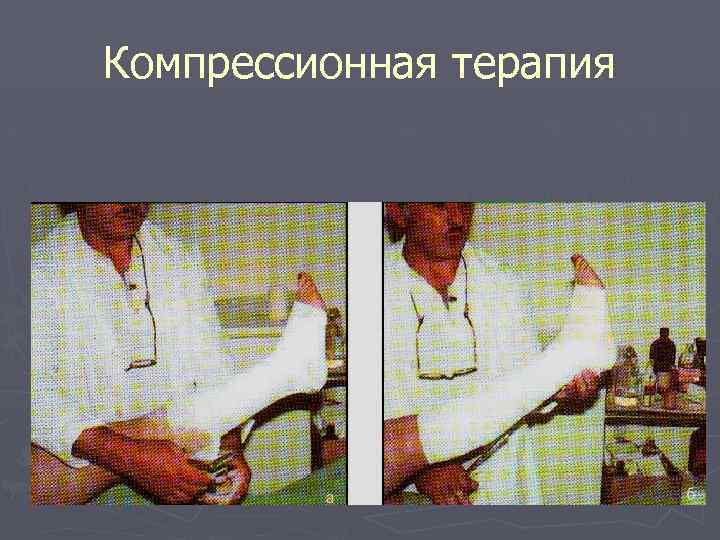 Компрессионная терапия 
