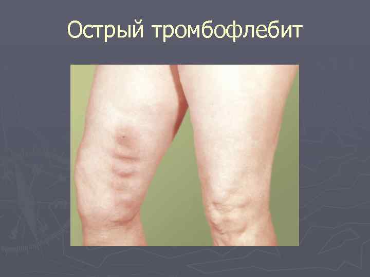 Острый тромбофлебит 