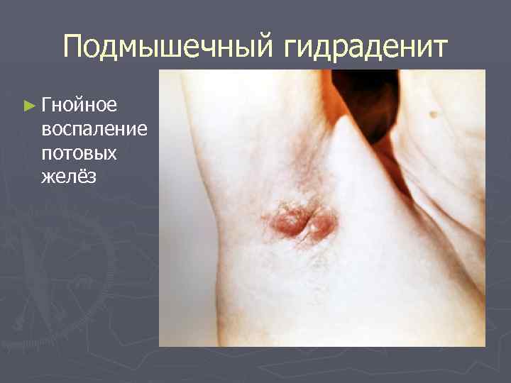 Подмышечный гидраденит ► Гнойное воспаление потовых желёз 