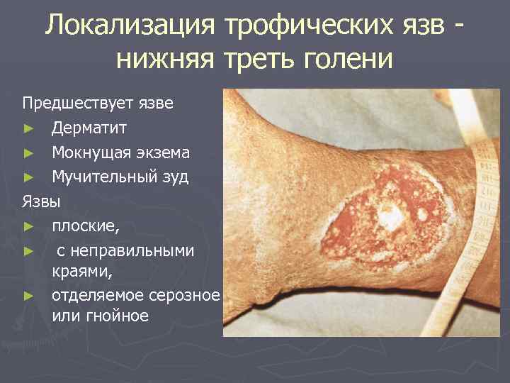 Локализация трофических язв - нижняя треть голени Предшествует язве ► Дерматит ► Мокнущая экзема