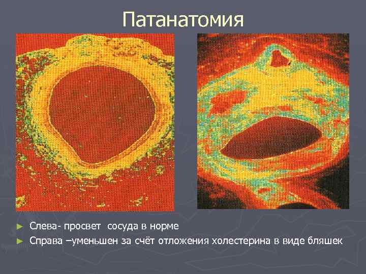 Патанатомия Слева- просвет сосуда в норме ► Справа –уменьшен за счёт отложения холестерина в