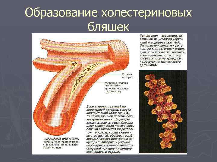 Образование холестериновых бляшек 