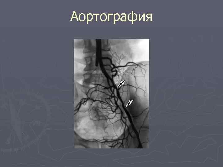 Аортография 