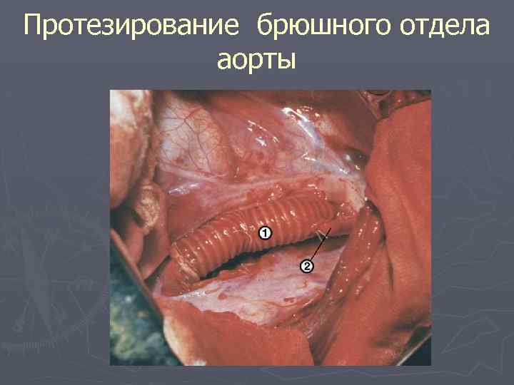 Протезирование брюшного отдела аорты 