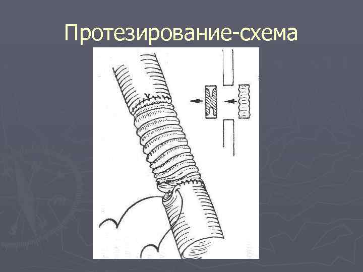 Протезирование-схема 