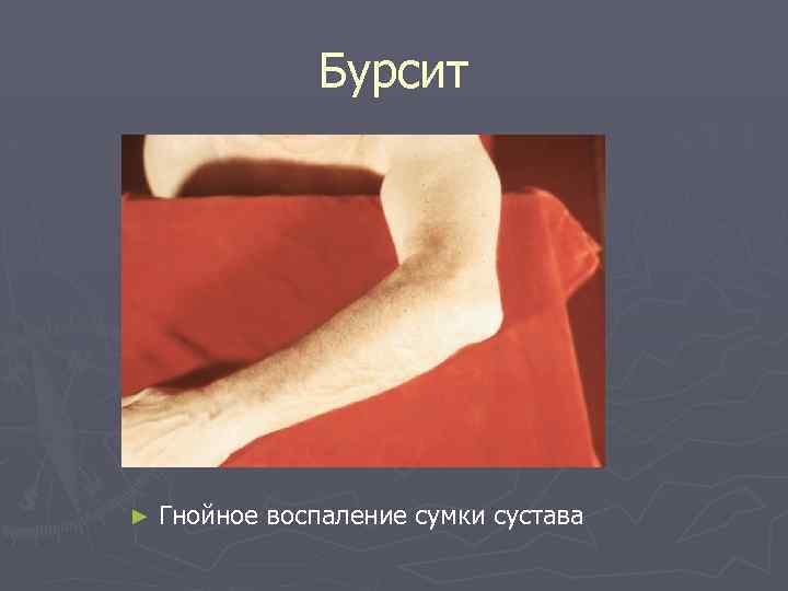 Бурсит ► Гнойное воспаление сумки сустава 