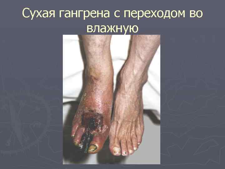 Сухая гангрена с переходом во влажную 