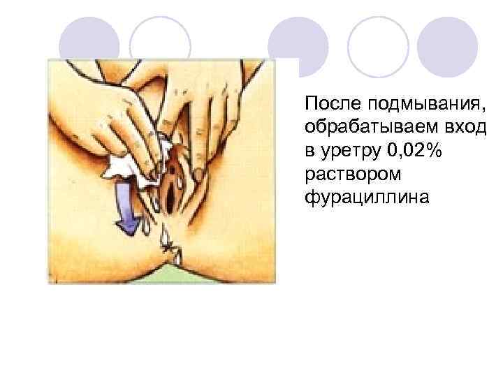 l После подмывания, обрабатываем вход в уретру 0, 02% раствором фурациллина 