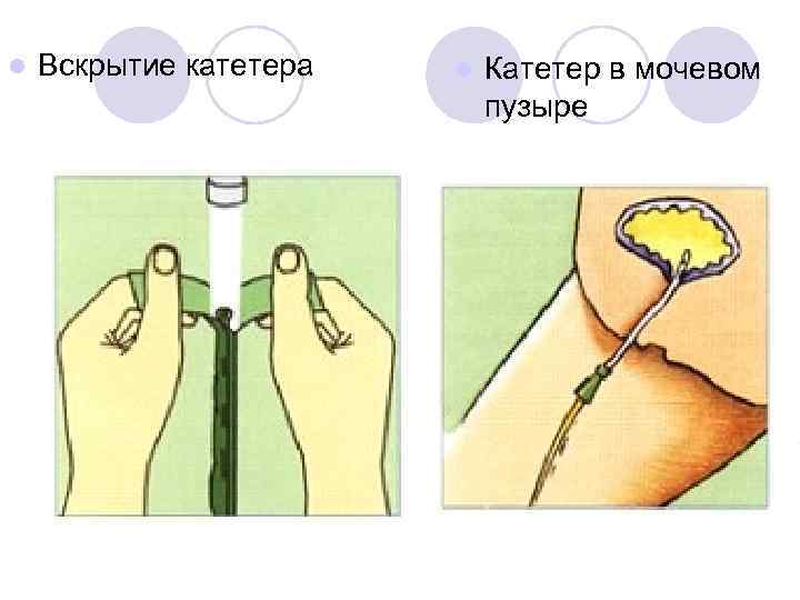 l Вскрытие катетера l Катетер в мочевом пузыре 