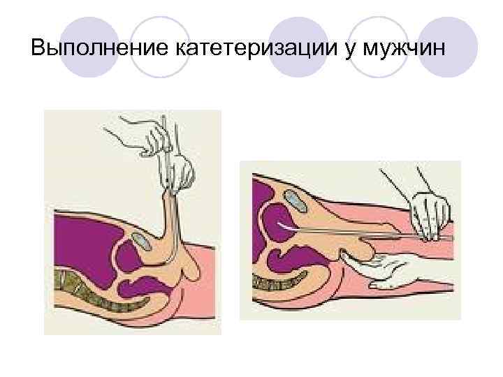 Выполнение катетеризации у мужчин 