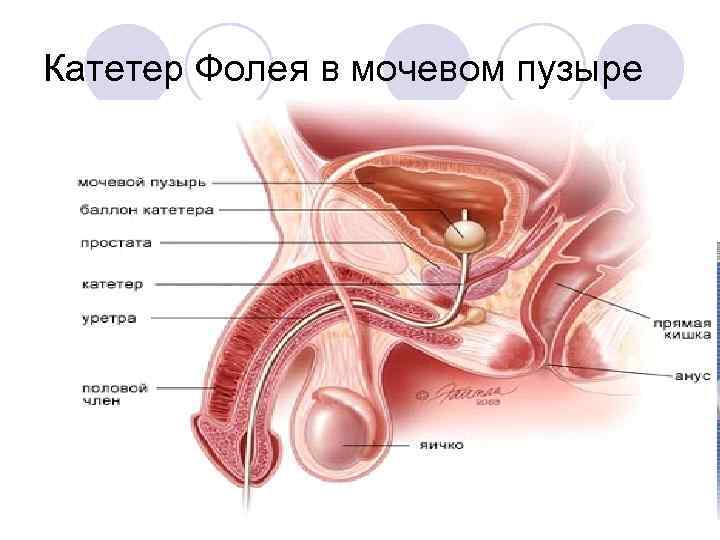 Катетер Фолея в мочевом пузыре 