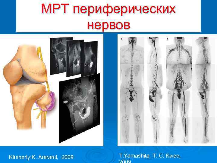 МРТ периферических нервов Kimberly K. Amrami, 2009 T. Yamashita, T. C. Kwee, 