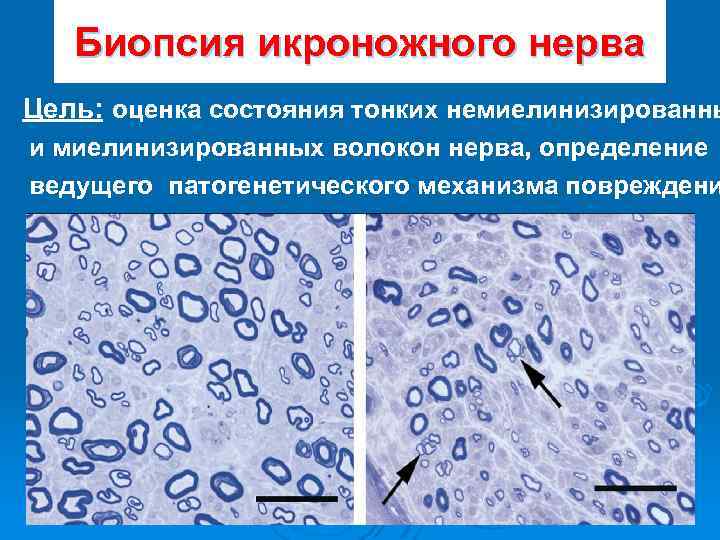 Биопсия икроножного нерва Цель: оценка состояния тонких немиелинизированны и миелинизированных волокон нерва, определение ведущего