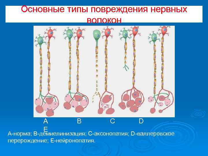 Основные типы повреждения нервных волокон А E В С D А-норма; В-демиелинизация; С-аксонопатия; D-валлеровское