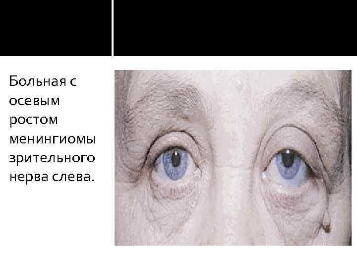 Больная с осевым ростом менингиомы зрительного нерва слева. 