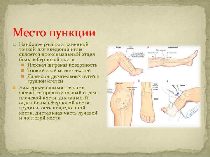 Место пункции p Наиболее распространенной точкой для введения иглы является проксимальный отдел большеберцовой кости