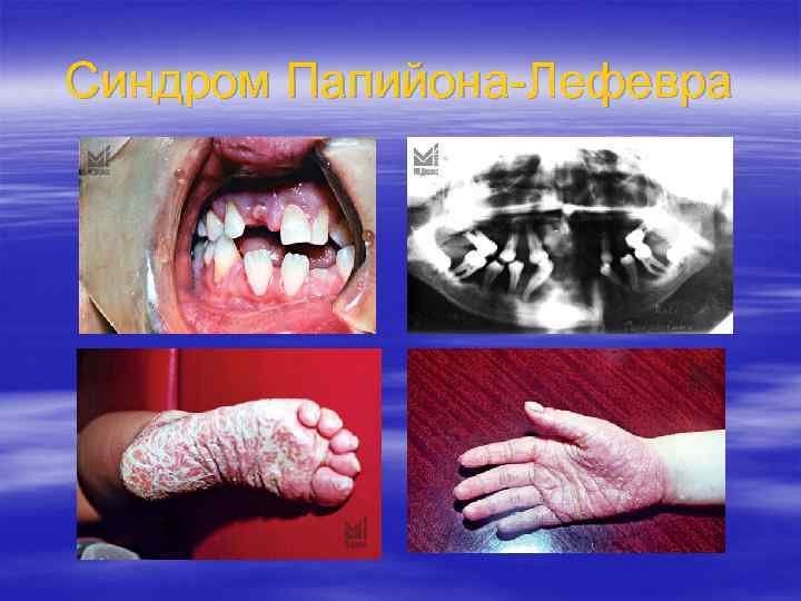 Синдром Папийона-Лефевра 