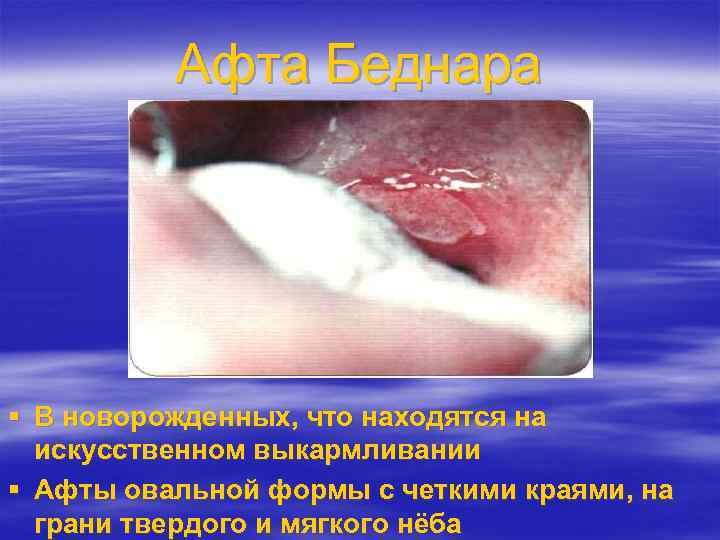Афта Беднара В новорожденных, что находятся на искусственном выкармливании Афты овальной формы с четкими