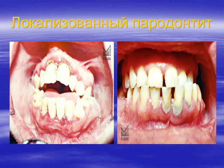 Локализованный пародонтит 