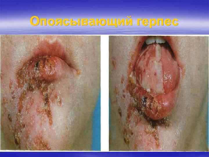 Опоясывающий герпес 