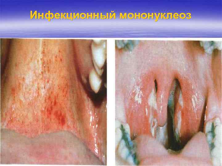 Инфекционный мононуклеоз 