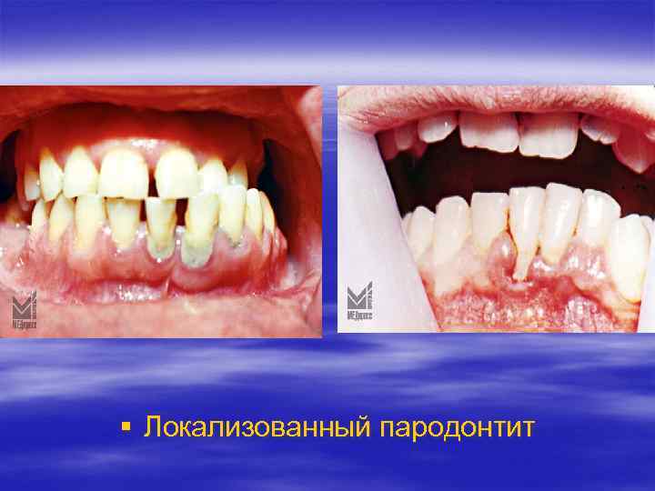  Локализованный пародонтит 