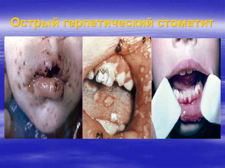 Острый герпетический стоматит 