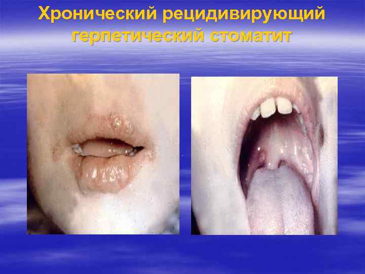 Хронический рецидивирующий герпетический стоматит 