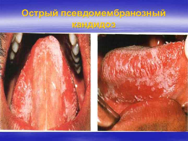 Острый псевдомембранозный кандидоз 